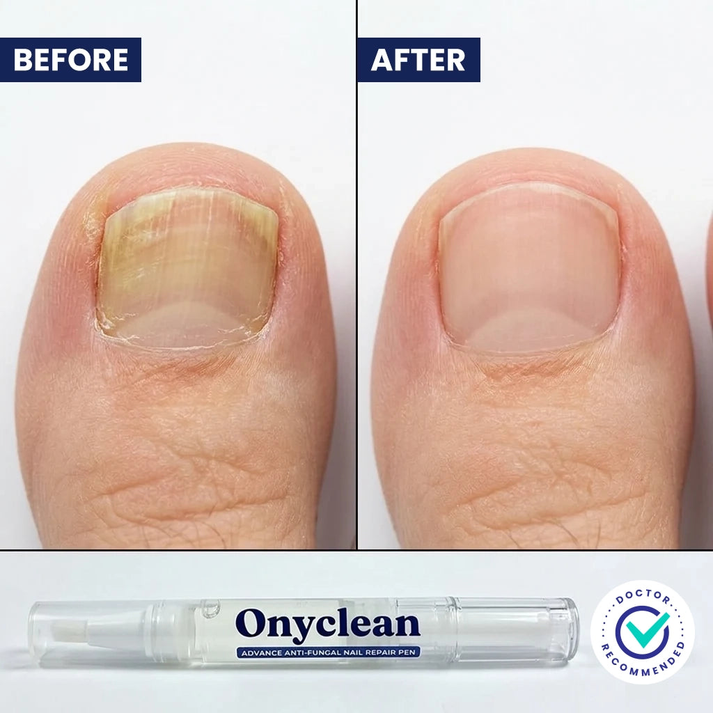 Onyclean