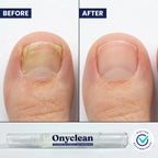 Onyclean